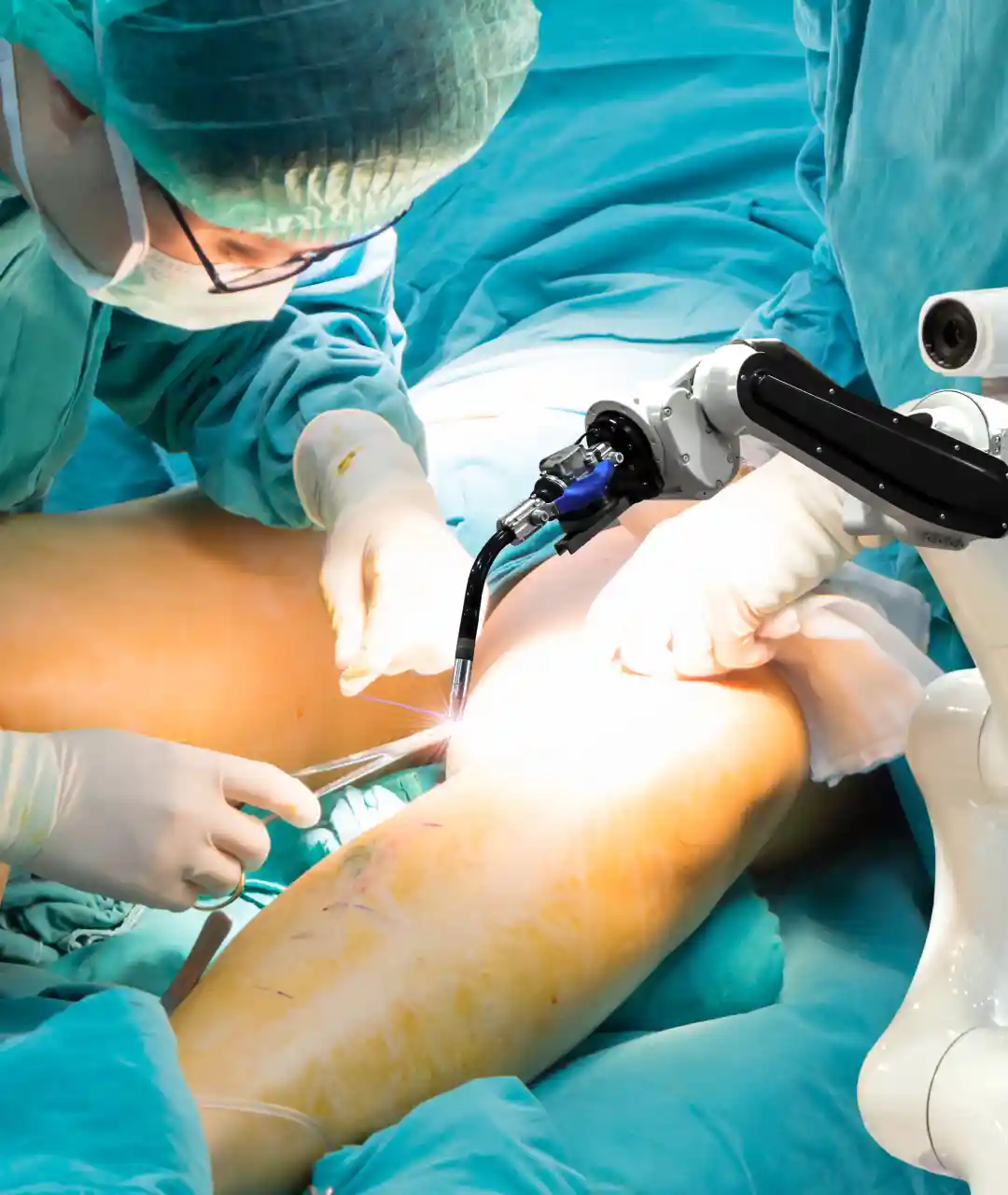 Angioplastia en Puebla
