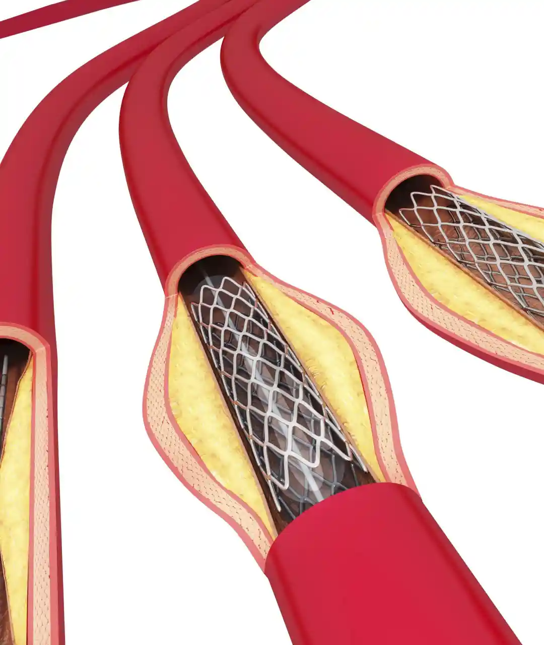 Colocación de Stents en Puebla