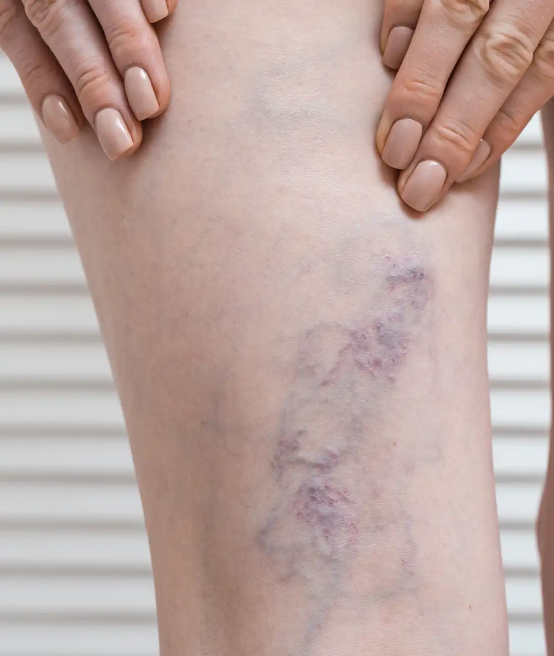 Escleroterapia con Microespuma en Puebla