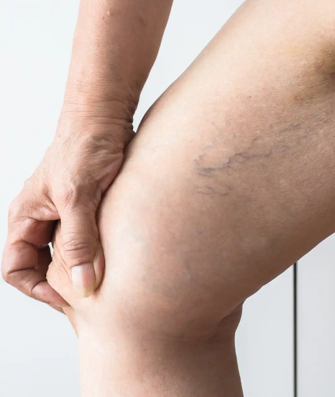 Terapia Vascular No Invasiva en Puebla