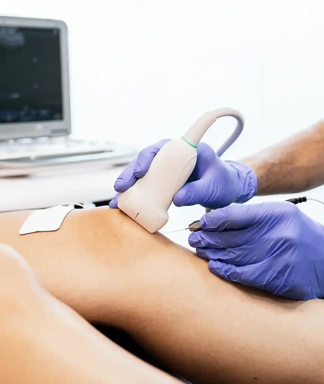 Tratamiento para Flebitis en Puebla