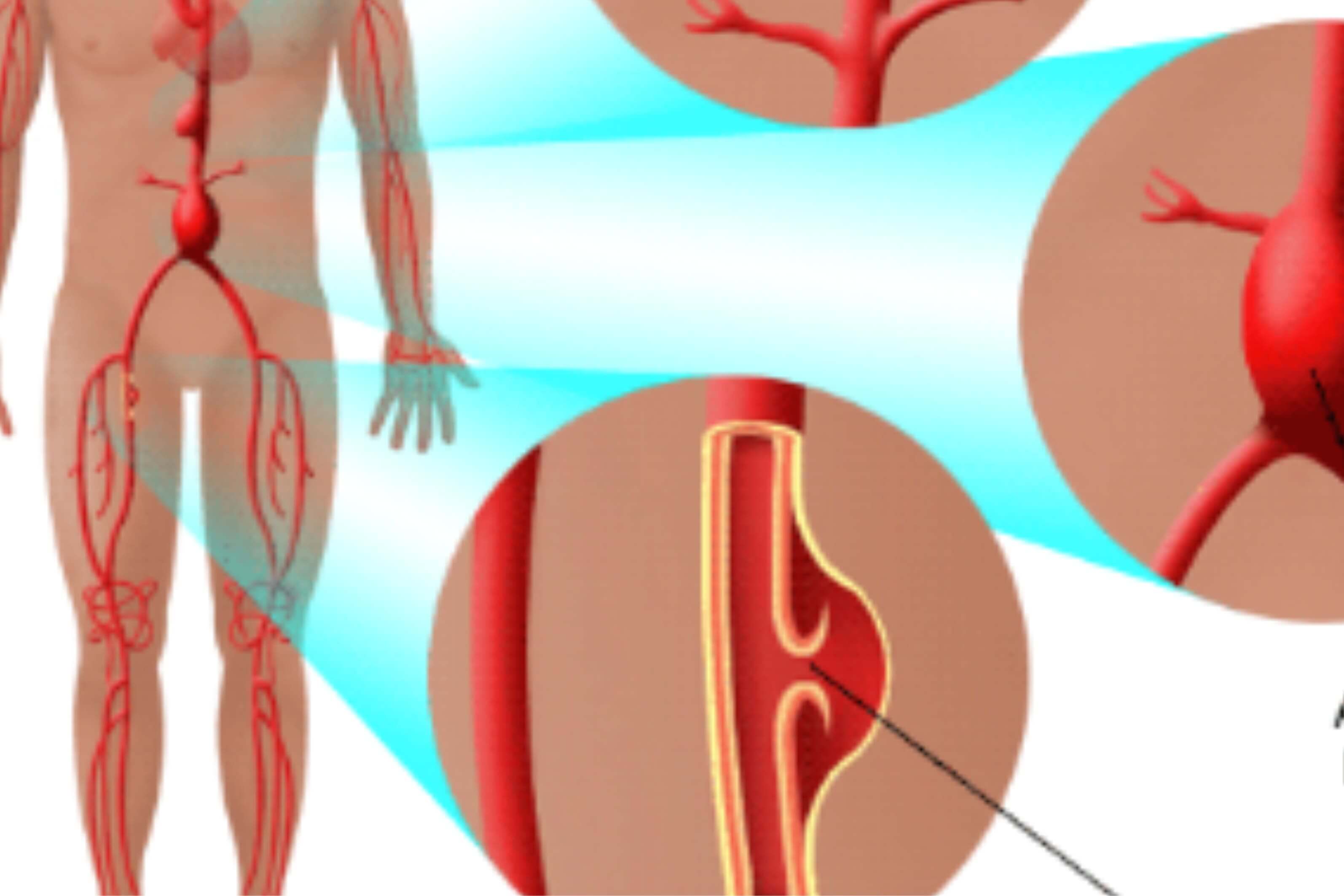 Manejo de Aneurismas y Pseudoaneurismas Periféricos
