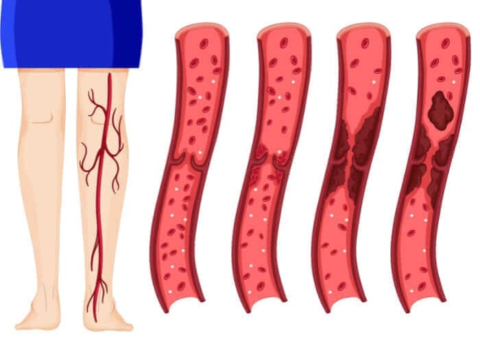 Tratamiento Integral de Trombosis Venosa Profunda